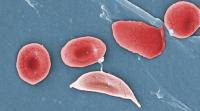 red blood cells, including sickled cell, as seen through a microscope